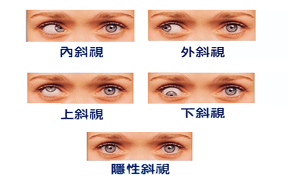 怎样治疗斜视俗称斗鸡眼斜眼